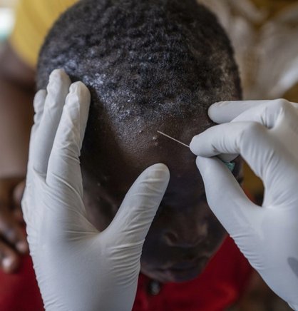 A health care provider examines a child for signs of mpox. Children are at high risk during the Mpox outbreak in North Kivu, where the disease has claimed many young lives. Photo: PATH/Moses Sawasa.