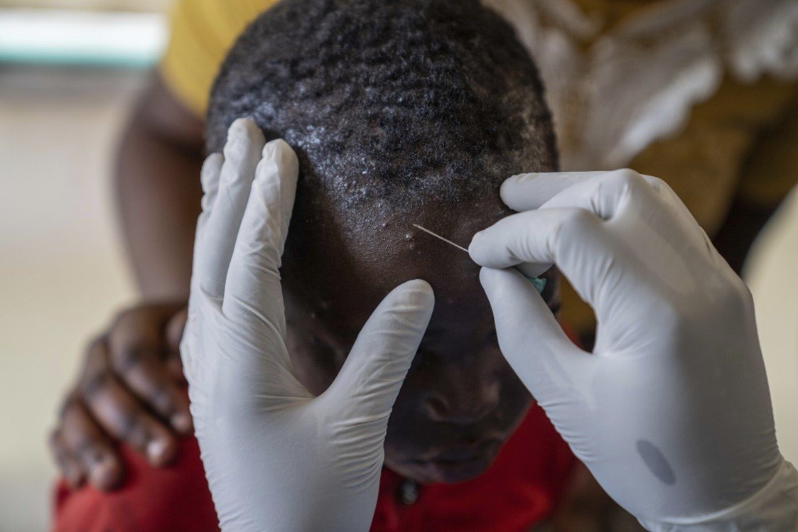 A health care provider examines a child for signs of mpox. Children are at high risk during the Mpox outbreak in North Kivu, where the disease has claimed many young lives. Photo: PATH/Moses Sawasa.