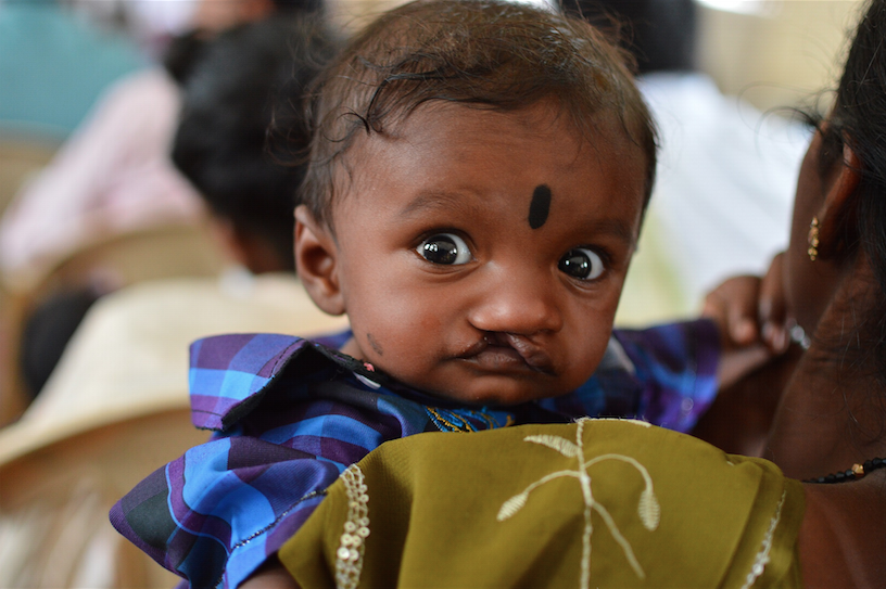 Indian baby with cleft lip.